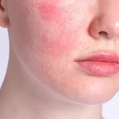 Чувствителна  кожа