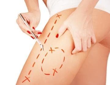 Пластичната хирургия в помощ на борбата със затлъстяването